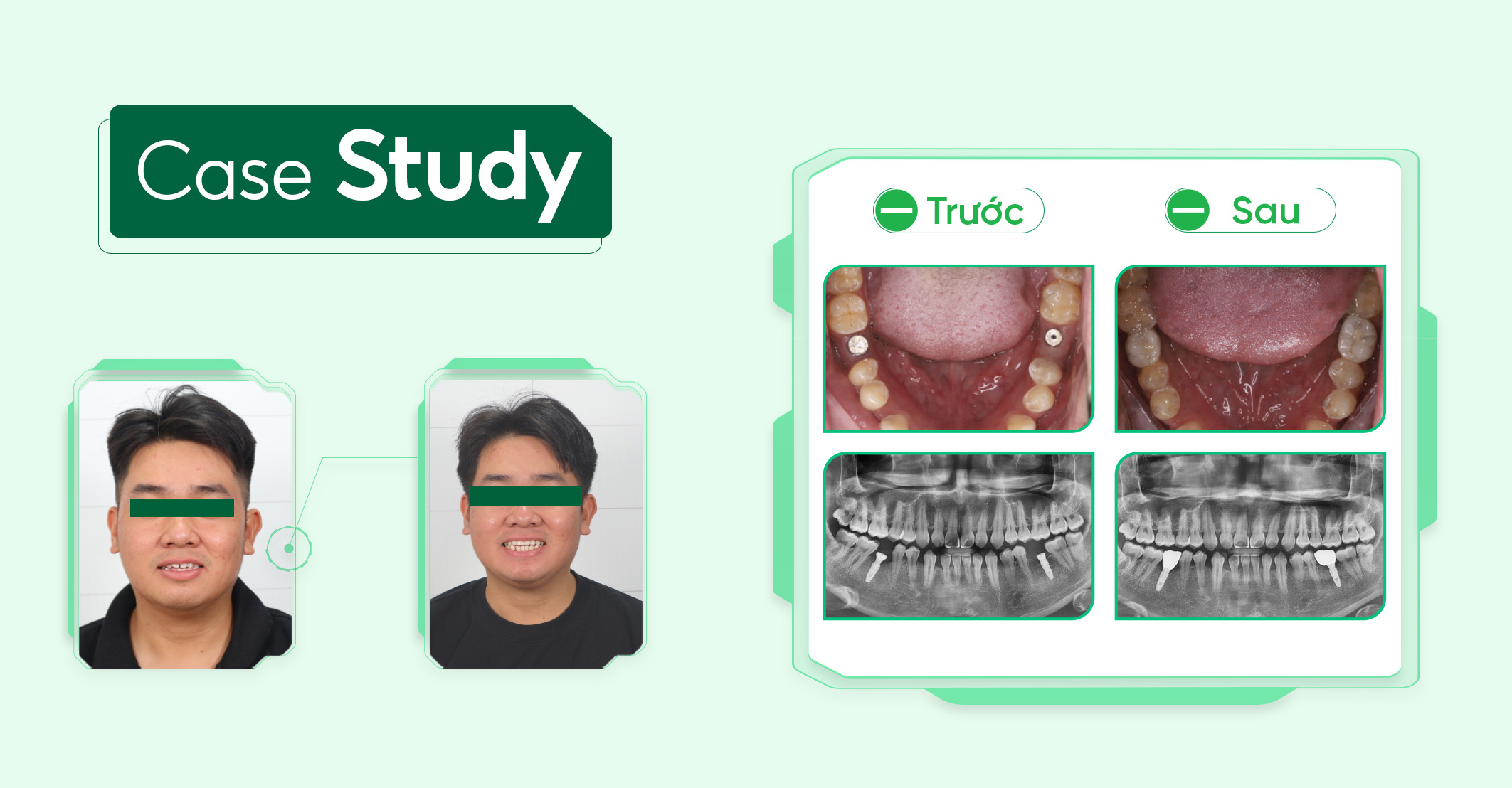 Case-phuc-hinh-rang-sư (3)