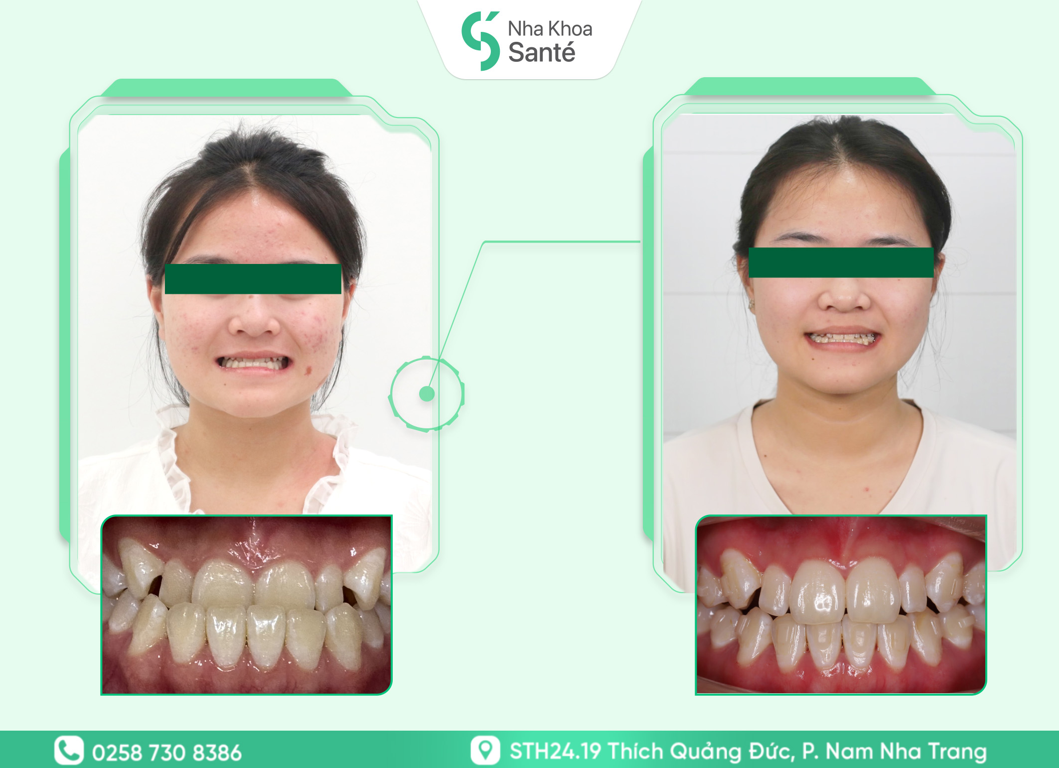Case-smartee ( 1 )